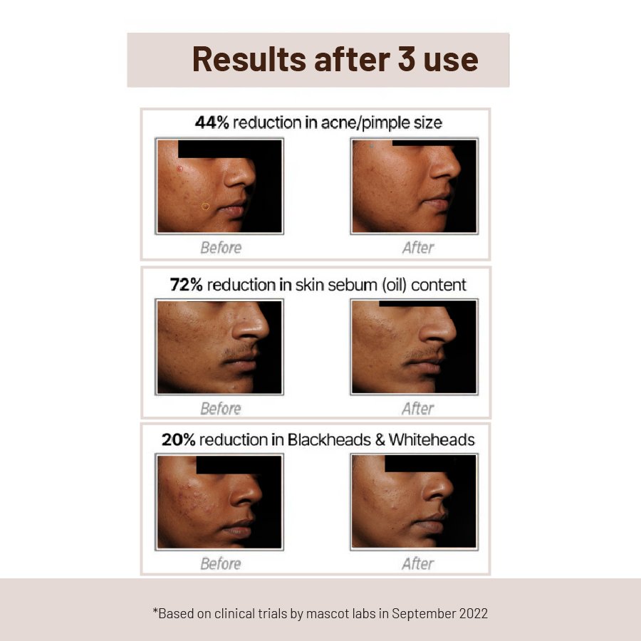 Acne Control Mask 60g